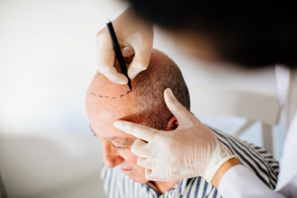 hair transplant costs in India
