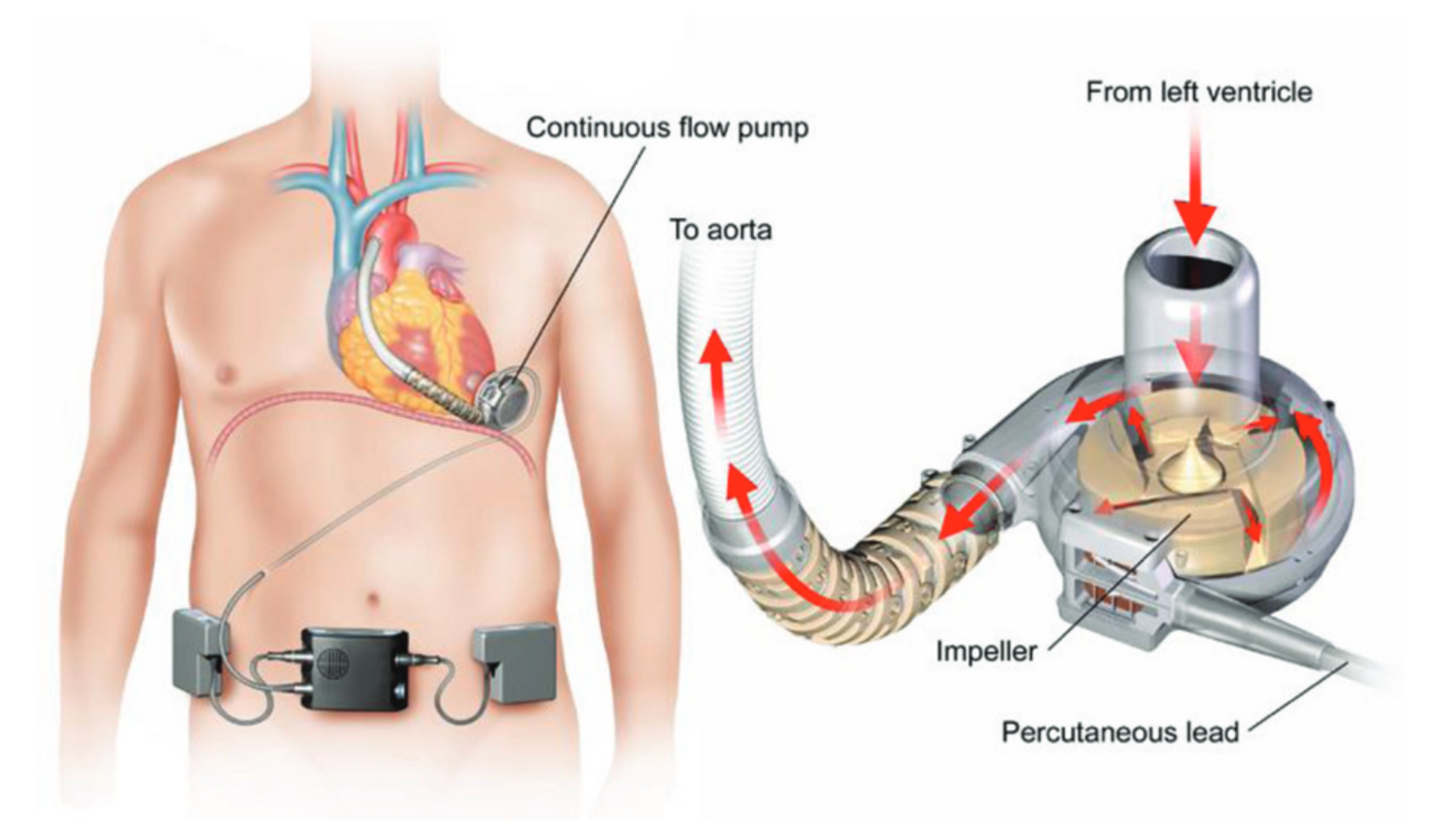 ventricular-assist-devices-market-share-report-2022-2027